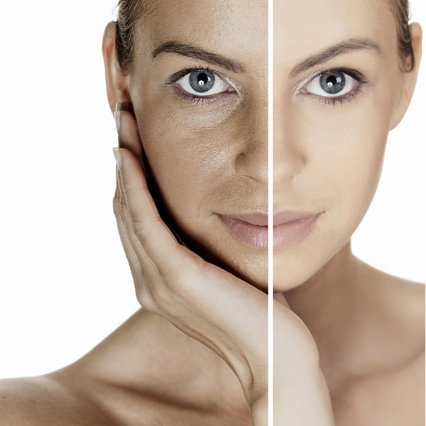 Adena Ipl Skin Treatment Christchurch (2) Facial treatments in Darfield at beauty lies within