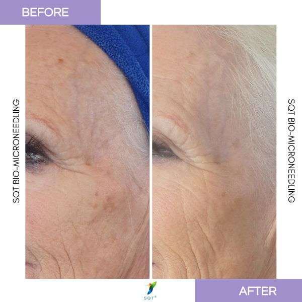 SQT Revitalizing Bio-Micro Needling Treatment Sqt Bio Microneedling Results at Beauty lies within Christchurch