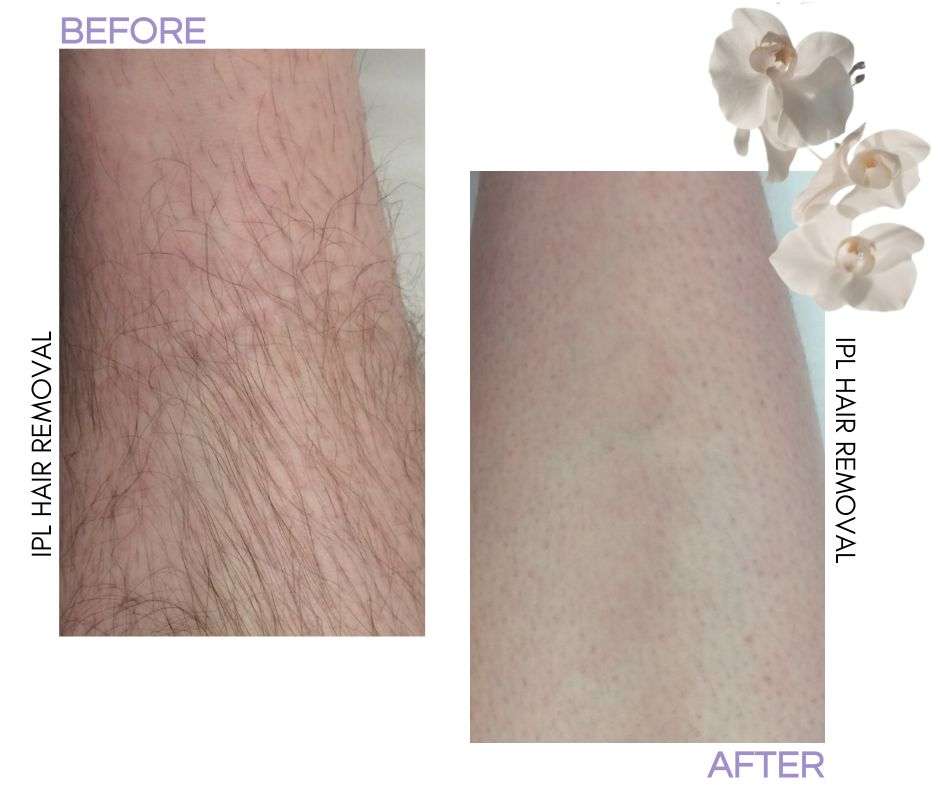 FACEBOOK-POST-BEFORE-AND-AFTER-at-Beauty-lies-within ipl-laser-hair-removal-treatment-at-beauty-lies-within-in-fendalton-christchurch