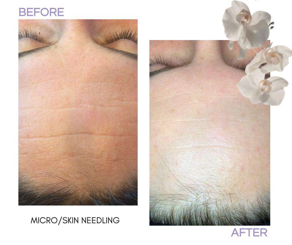Microneedling for Anti-ageing at Beauty lies within Christchurch (2) (1) Microneedling Treatment Before and After for Anti-ageing at Beauty lies within Christchurch