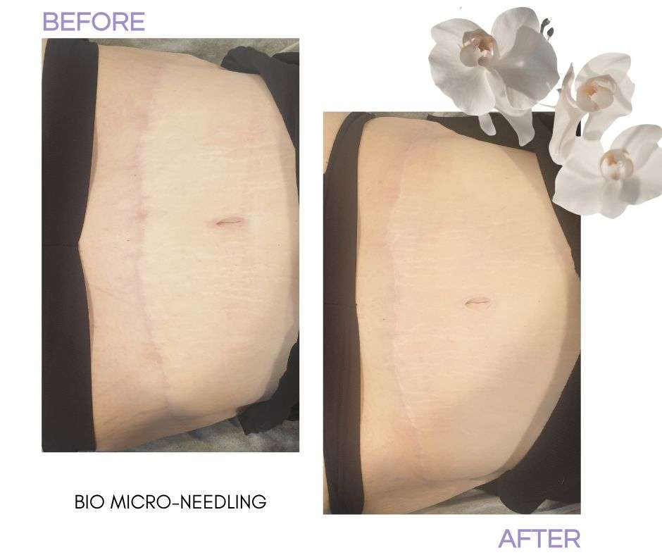 Sqt Bio Microneedling at Beauty lies within Christchurch (3) Sqt Bio Microneedling Treatment Beauty lies within Christchurch