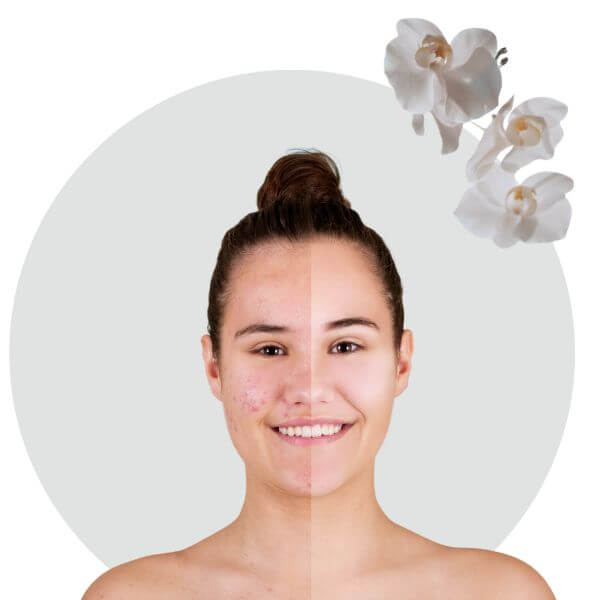 Ipl Skin Rejuvenation at Beauty lies within Bryndwr Christchurch NZ Before and After an Ipl Skin Rejuvenation at Beauty lies within Bryndwr Christchurch NZ