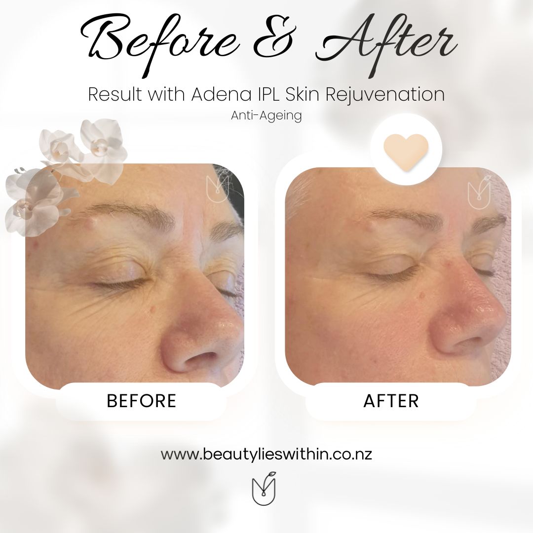 Adena IPL Skin Rejuvenation Anti Ageing