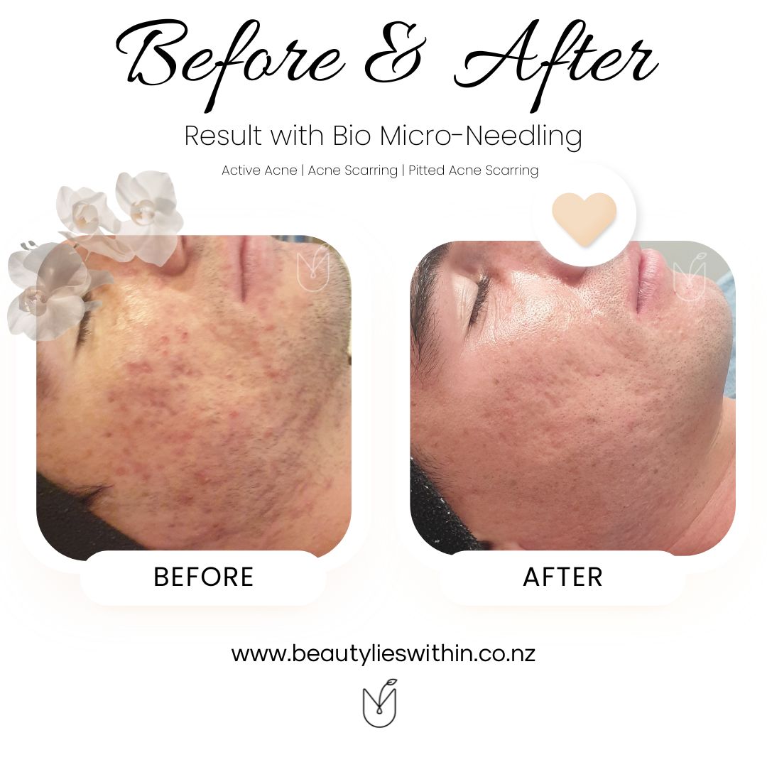 Bio Micro Needling Acne Acne Scarring (1)