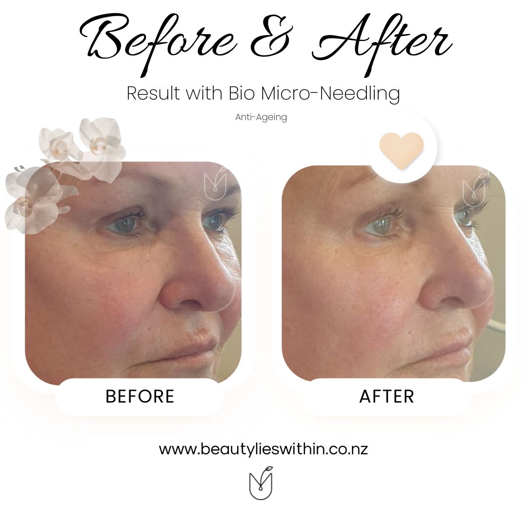 Bio Micro Needling Anti Ageing (1)