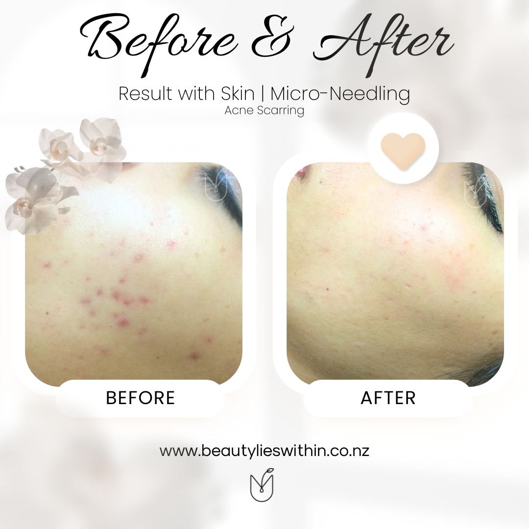 Skin Micro Needling Acne Scarring