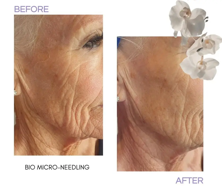 Sqt Bio Microneedling at Beauty lies within Christchurch 1 1