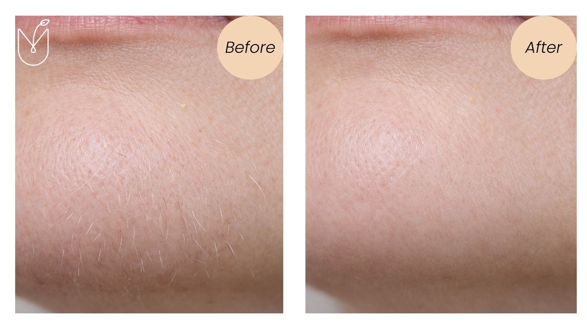 Adena IPL Treatment Comparison